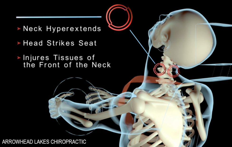 Video of effects of whiplash